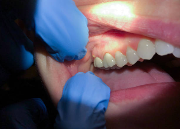 Best Emergency Care for Gum Disease in Rutherford College, NC