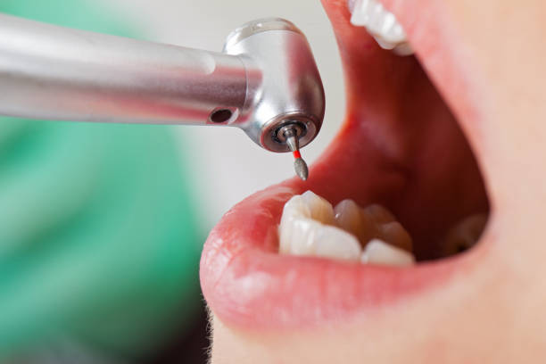 Best Emergency Root Canal Therapy in Rutherford College, NC